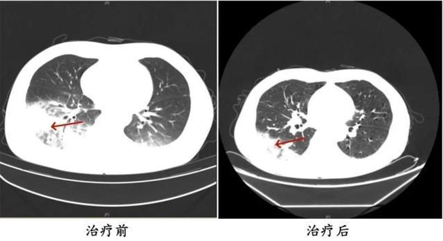 吹了3天空调，男子左肺“白”了一半！紧急提醒→