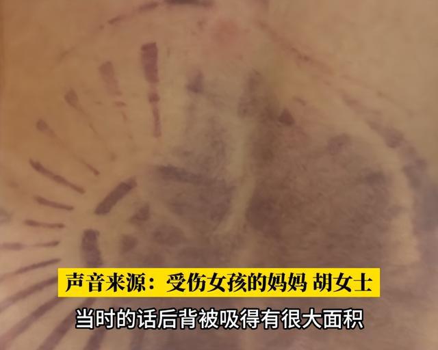 男孩整条左腿被泳池死死“咬住”，紧急提醒：不要靠近